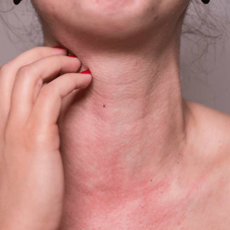 allergia al nichel cover